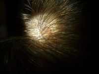 Leberfleck auf der Haut mit Haaren.jpg